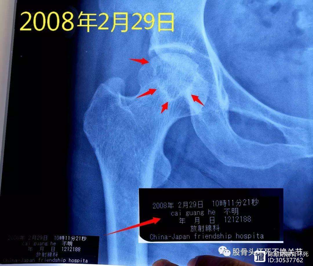 合肥人工骨头医保报销多少(人工骨头医保报销多少比例)